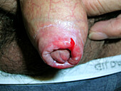 Thrush infection of the penis