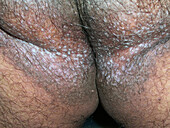 Darier's disease