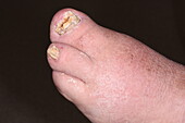 Congenital absence of two toes