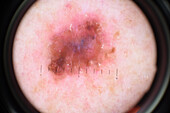 Malignant melanoma, dermatoscope image