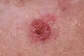 Nodular basal cell carcinoma