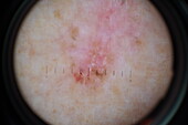 Basal cell carcinoma, dermatoscope image