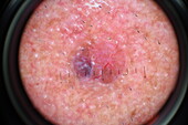 Basal cell carcinoma, dermatoscope image