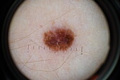 Melanoma in situ, dermoscope image