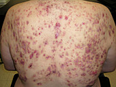 Acne conglobata and hidradenitis suppurativa after treatment