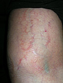 Atopic and seborrhoeic dermatitis