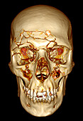 Face and skull fractures, CT scan