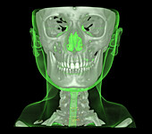 Skull and neck, CT scan