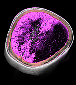 Ischaemic stroke, CT scan