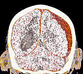 Subdural haemorrhage, CT scan