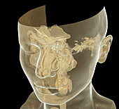 Upper respiratory tract, CT scan