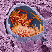 Cholesterol crystals in liver, SEM