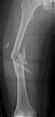 Fractured femur, X-ray