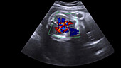 Foetal heart, ultrasound scan