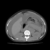 Ascites, CT scan