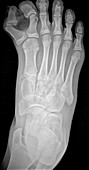 Extra toe, X-ray