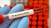 Haemophilia blood test, conceptual image