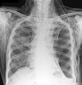 Subcutaneous emphysema, X-ray