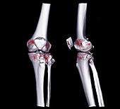Fractured shin bone, 3D CT scans