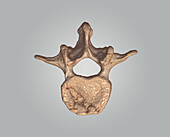 Spinal fracture, 3D CT scan