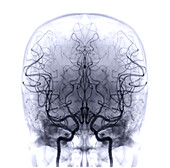 Cerebral arteries, angiogram