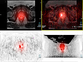 Prostate cancer, PET and MRI scans