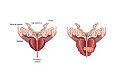 Healthy and cancerous prostate glands, illustration