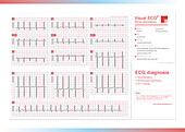 Atrial fibrillation, illustration