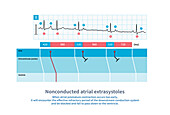 Nonconducted atrial extrasystoles, illustration