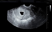 Embryo at five weeks, ultrasound scan