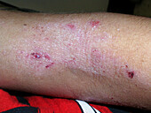 Atopic dermatitis