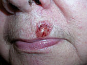 Basal cell carcinoma