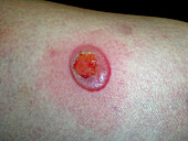 Bullous pemphigoid