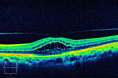 Cystoid macular oedema, OCT scan