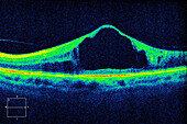 Diabetic macular oedema, OCT scan