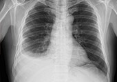 Pleural effusion, X-ray