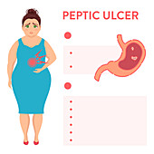 Peptic ulcer symptoms, illustration