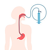 Nasogastric tube, illustration