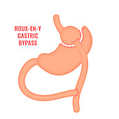 Roux-en-y gastric bypass bariatric surgery, illustration
