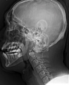 Dislocated neck bones, X-ray