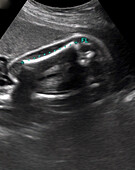 Foetal thigh bone, ultrasound scan