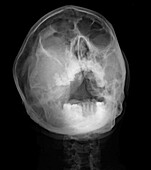 Maxillary mass, X-ray