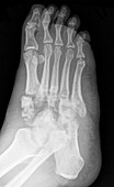 Bone infection, X-ray