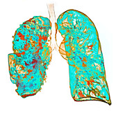 Pneumonia, 3D CT scan