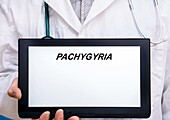 Pachygyria, conceptual image