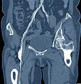 Femoral aneurysm, CT scan