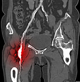 Femoral aneurysm, CT scan