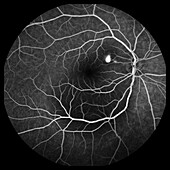 Central serous retinopathy, angiogram