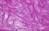 Fibrin substance, light micrograph
