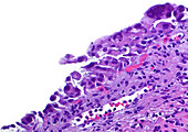 Bladder in situ cancer, light micrograph